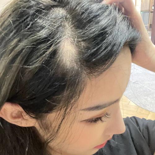 网红脱发,网红脱发背后的真相与应对策略