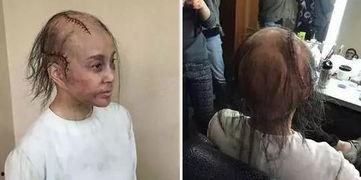 哪些明星得脑瘤,揭秘患脑瘤的明星们