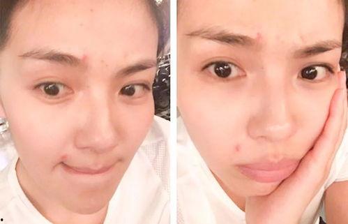 哪个明星脸上长痘痘