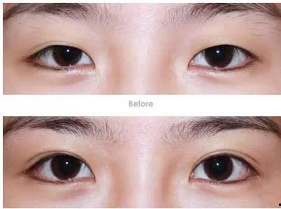 哪些明星做过双眼皮,揭秘明星双眼皮整形风潮